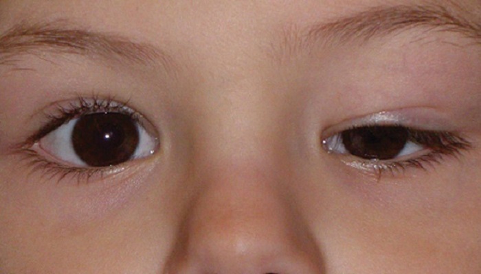 عوامل ایجاد تنبلی چشم کودکان