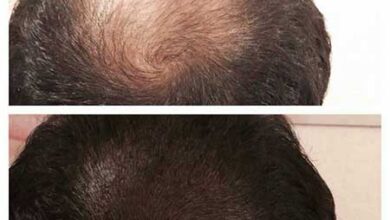 تکنیک اسکالپ موی سر چیست و تا چه مدت ماندگاری دارد؟