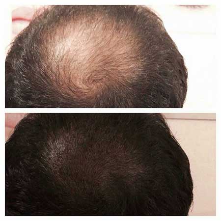 تکنیک اسکالپ موی سر چیست و تا چه مدت ماندگاری دارد؟