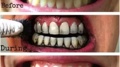 زغال فعال برای دندان