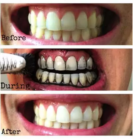 زغال فعال برای دندان