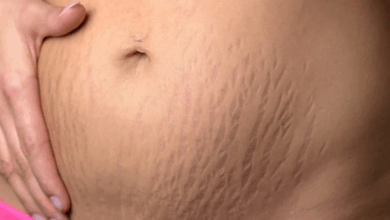 روش های درمانی برای ترک های پوستی؛ از درمان خانگی تا لیزر و روش های ترکیبی