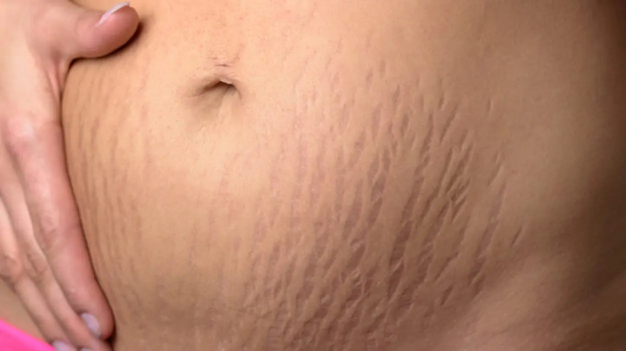 روش های درمانی برای ترک های پوستی؛ از درمان خانگی تا لیزر و روش های ترکیبی