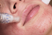 عوارض میکرونیدلینگ چیست؟