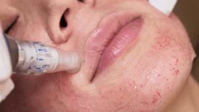 عوارض میکرونیدلینگ چیست؟