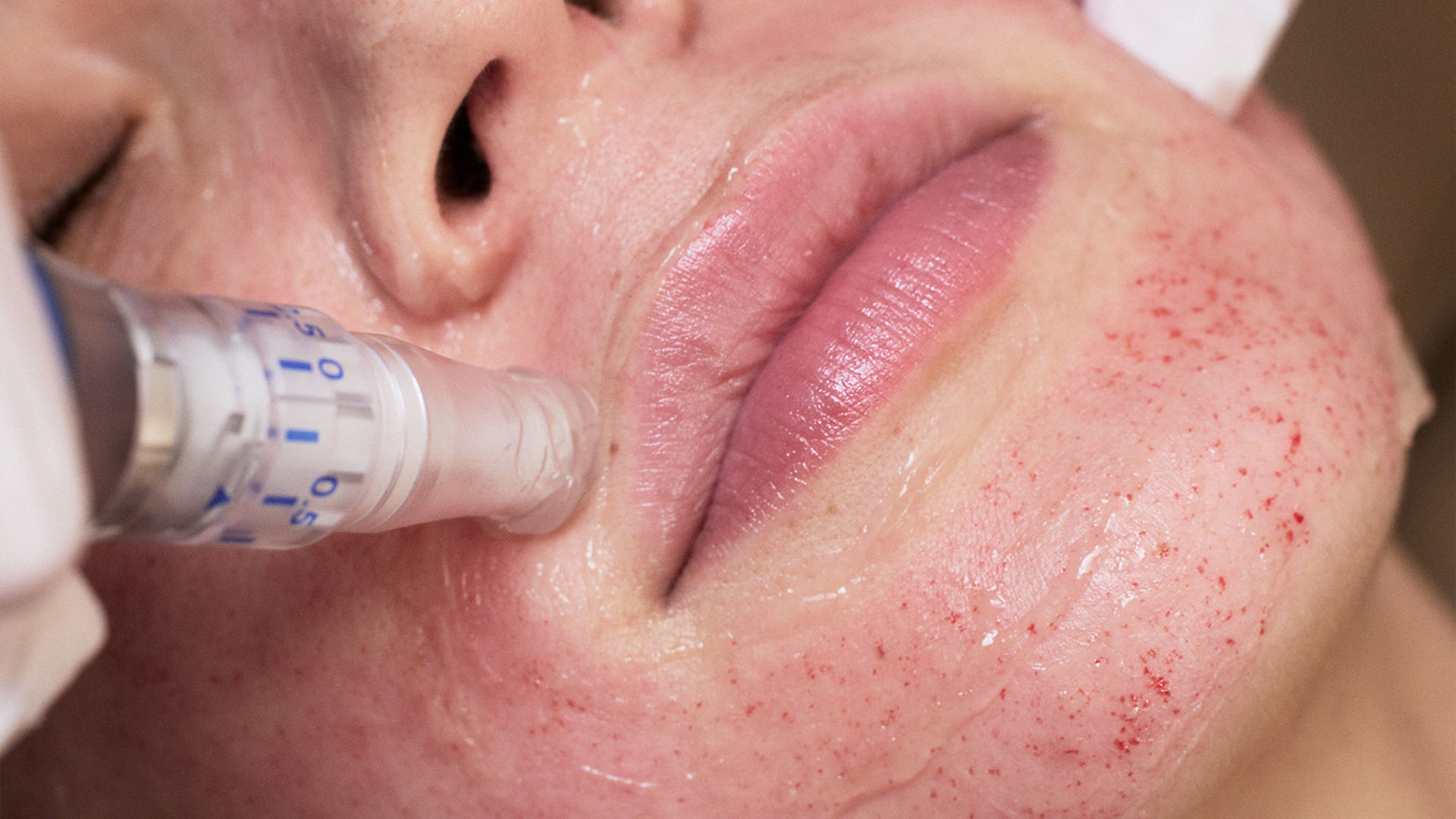 عوارض میکرونیدلینگ چیست؟